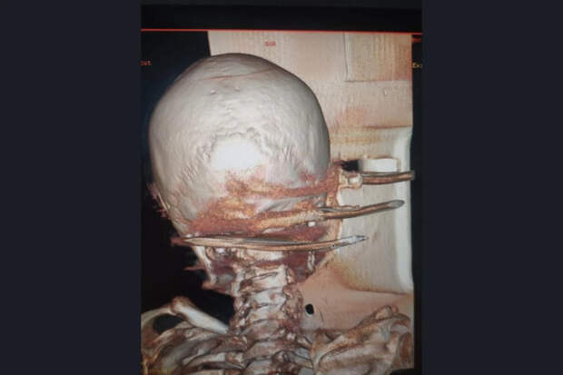 Сибиряк, который проткнул знакомому голову вилами, пойдет под суд