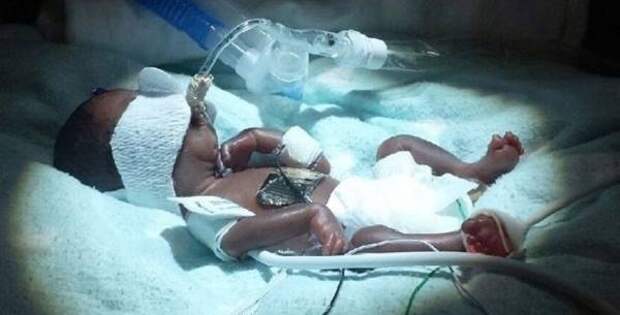 Крошечному преждевременно рожденному малышу весом 500 гр удалось выжить, несмотря ни на что