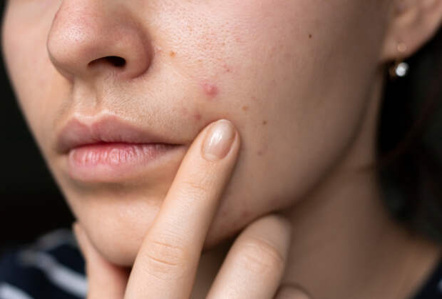 Россиян с запорами и прыщами предупредили о пикантном побочном эффекте от одного препарата