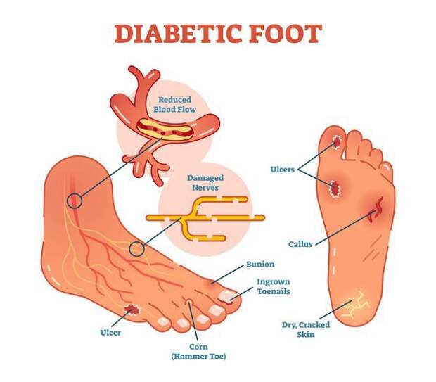 Диабетическая стопа: симптомы и лечение, стадии диабетической стопы, уход зав ногами при сахарном диабете