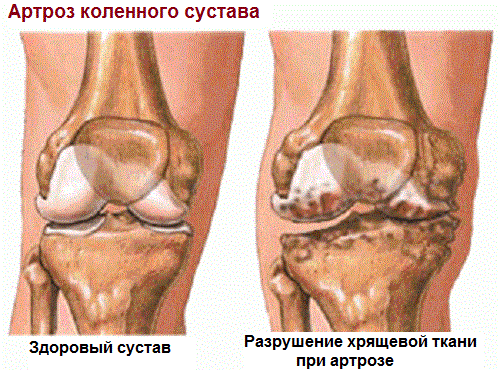 Это нужно знать: Разница между артрозом, артритом и остеопорозом